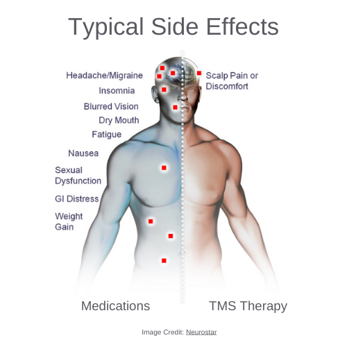 side effects of TMS Therapy
